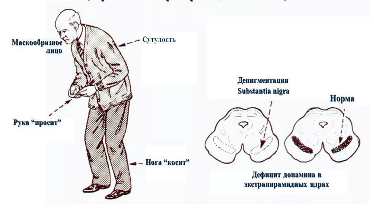 Клинические проявления болезни Паркинсона. Причины паркинсонизма. Клинические синдромы при болезни Паркинсона. Болезнь Паркинсона 2 ст.