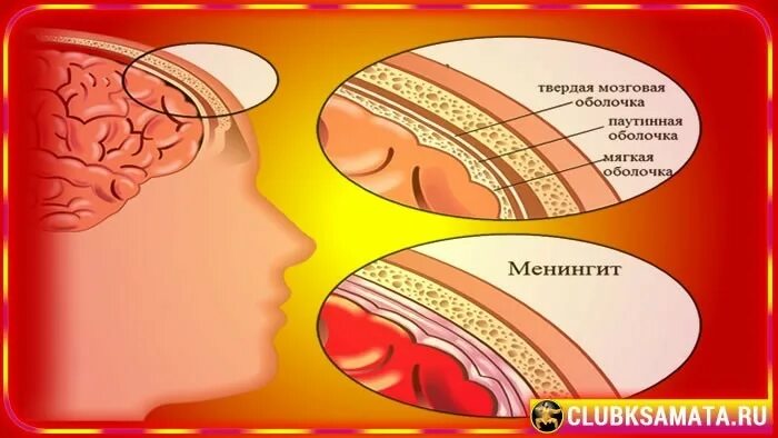 Воспаление оболочек головного мозга. Воспаление оболочки мозга фото. Воспалений мозговой корочки. Воспаление головного мозга латынь