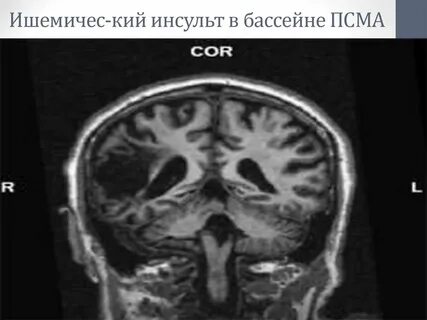 Ишемический инсульт в бассейне
