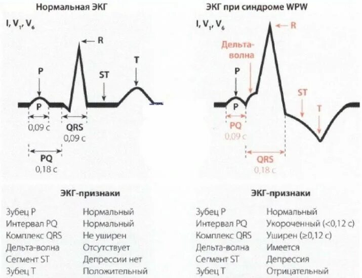 феномен wpw на экг. Wpw синдром экг. впв расшифровка. впв расшифровка. вольфа паркинсона уайта на экг.