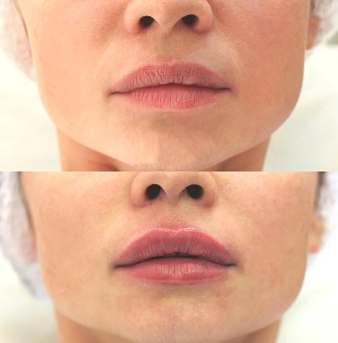 контур губ гиалуроновой кислотой 1 мл. накачать филлер. ковынцев хейлопластика. уколы губ гиалуроновой кислотой до и после. губы накаченные гиалуроновой кислотой 0.