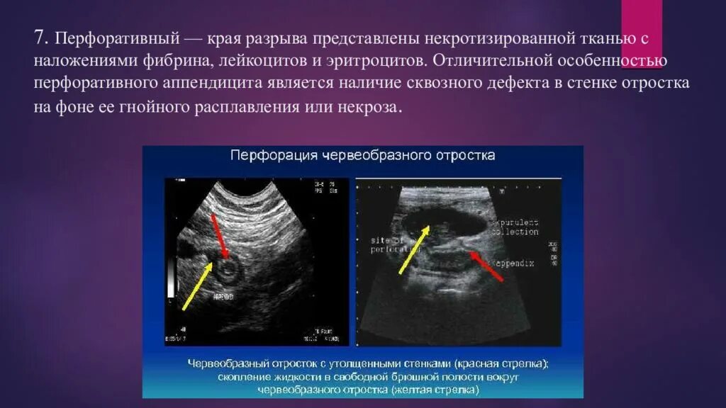 Перфорация червеобразного отростка. УЗИ брюшной полости при аппендиците.