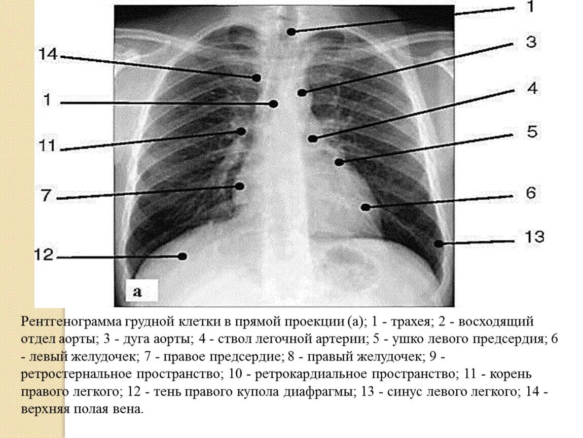 Базальные отделы легких. Рентгенограммы грудной клетки прямая проекция. Дуга аорты на рентгенограмме. Базальные отделы легких на рентгене. Легкие в прямой проекции