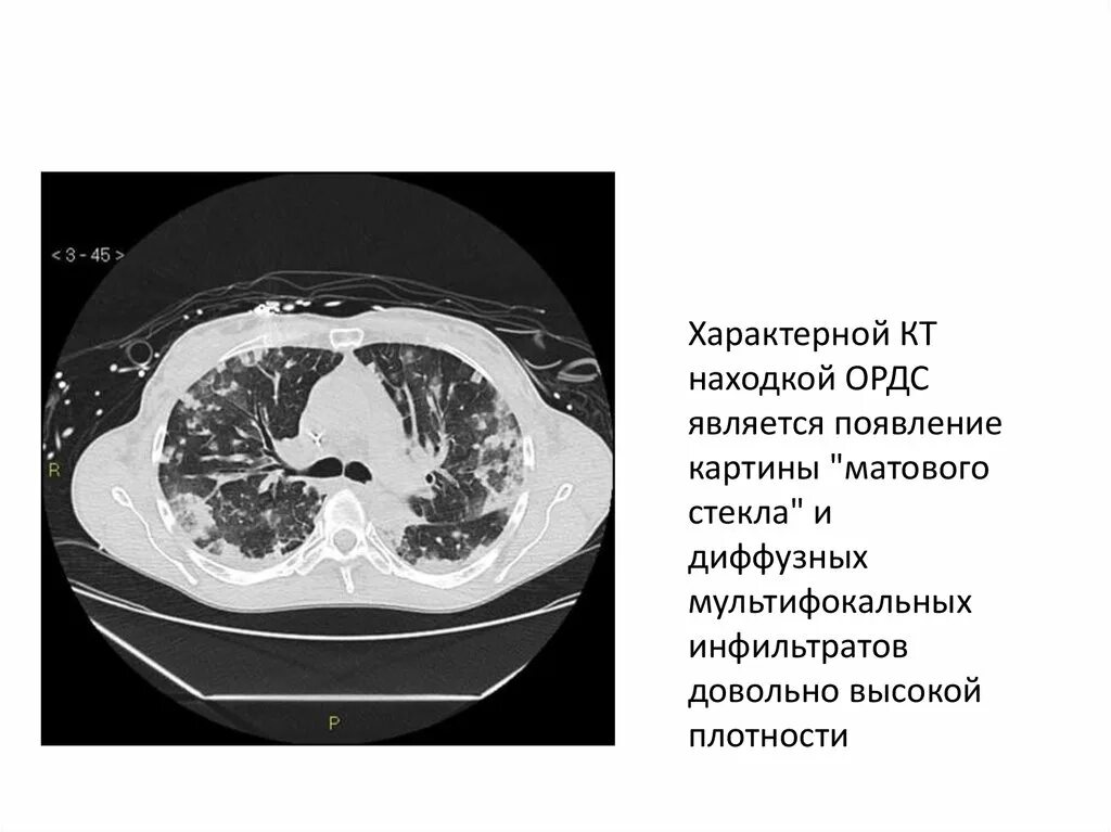 Респираторный дистресс синдром на кт. Дистресс синдром кт картина. Кт легких ковид