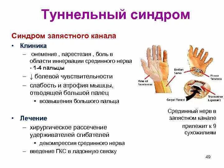 Онемение пальцев после операции. Туннельный синдром лучезапястного сустава. .Туннельный синдром запястья туннельный. Туннельные синдромы неврология. Что такое туннельный синдром запястья руки.