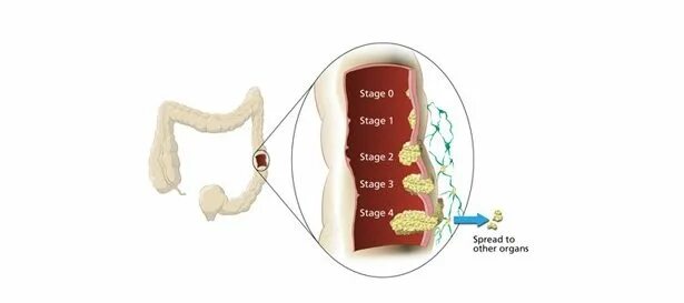 Метастазирующая опухоль кишечника. 4 Стадия метастазов в кишечнике что это. Метастазы прямой кишки симптомы.