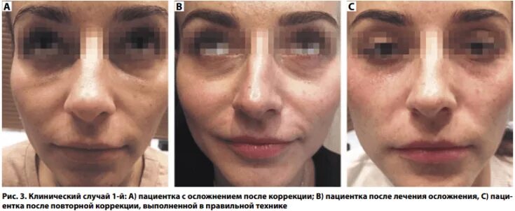 Филлеры после лонгидазы. Эффект Тиндаля в носослезной борозде. Эффект Тиндаля под глазами. Фиброз после филлера в носослезную борозду. Эффект Тиндаля в косметологии носослезной борозды.