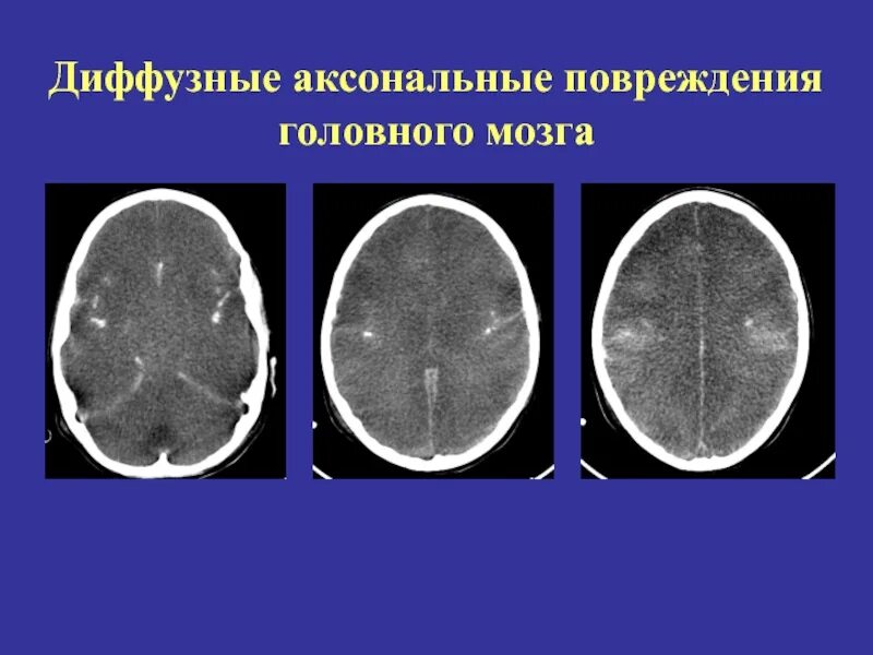 Аксональное повреждение мозга. Диффузное аксональное повреждение мозга кт. Диффузно аксональные повреждения головного мозга кт. Диффузное аксональное повреждение мрт. Диффузные аксональные повреждения головного мозга мрт.