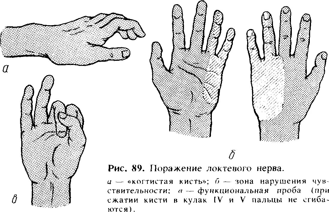 Симптомы поражения локтевого нерва неврология. Форма кисти при поражении локтевого нерва. Кисть при поражении локтевого нерва. Нейропатия локтевого нерва периоды.