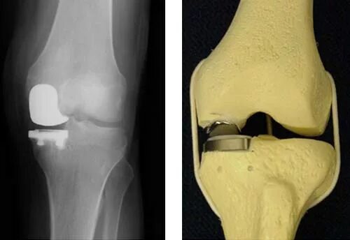 Артроз коленного сустава эндопротез. Эндопротез коленного сустава рентген. Артропластика коленного сустава. Эндопротезирование мыщелка коленного сустава.