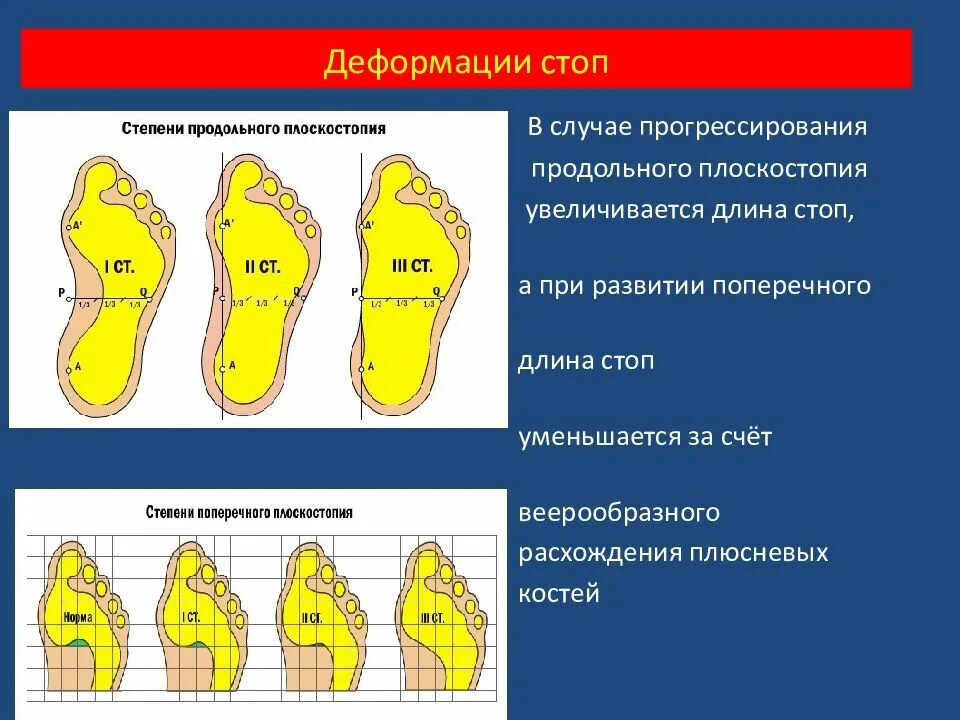 Степени вальгусной деформации. Степени плоскостопия вид сбоку. поперечное плоскостопие вид сзади. при плоскостопии 3 степени деформация. стадии деформации стопы.