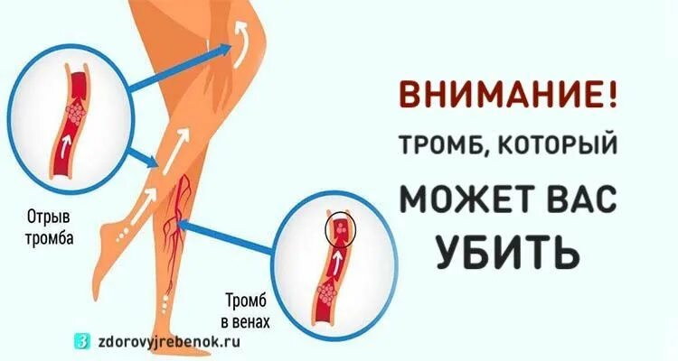 От чего отрывается тромб причины. Предпосылки тромба отрыв.