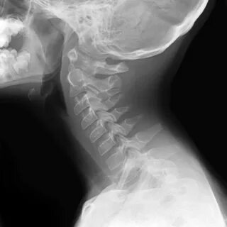 X ray extensions