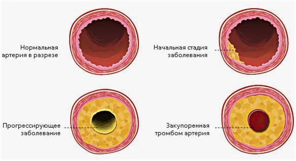 Стадии атеросклероза артерий