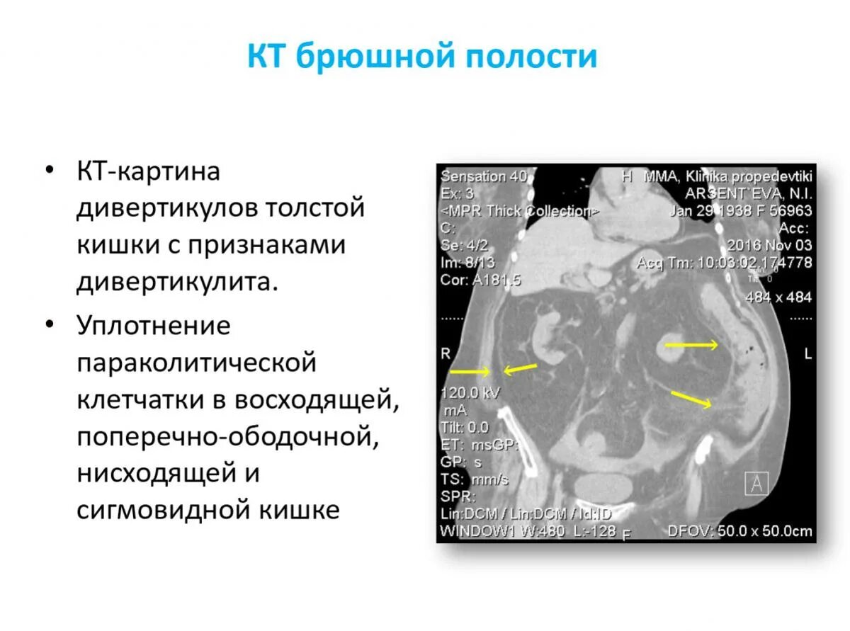 Дивертикулез сигмовидной кишки диета лечение. Дивертикулита сигмовидной кишки. Дивертикул сигмовидной кишки на УЗИ. Дивертикулы толстой кишки питание. Дивертикулит толстой кишки диета.