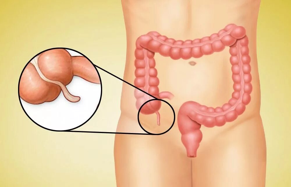 Аппендицит к какому врачу обратиться. Аппендикс это отросток слепой кишки. Червеобразный отросток кишечника. Слепая кишка аппендикс воспаление.