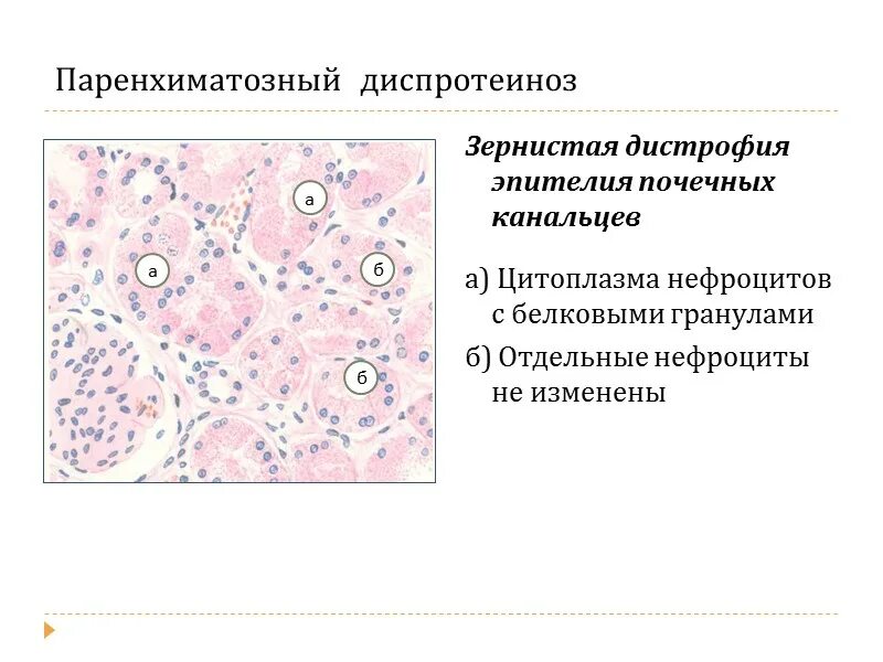 Гидропическая дистрофия эпителия проксимальных канальцев почки. Жировая дистрофия почек микропрепарат. Гидропическая белковая дистрофия. Гидропическая дистрофия почки макропрепарат. Белковые канальцы