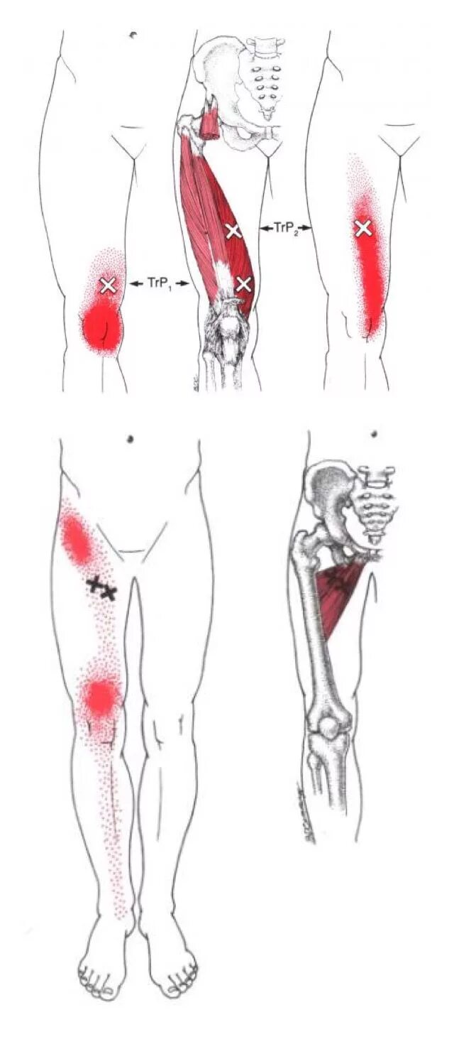 Триггерные точки при трохантерите. Триггерные точки мышц бедра. Болит колено триггерные точки.