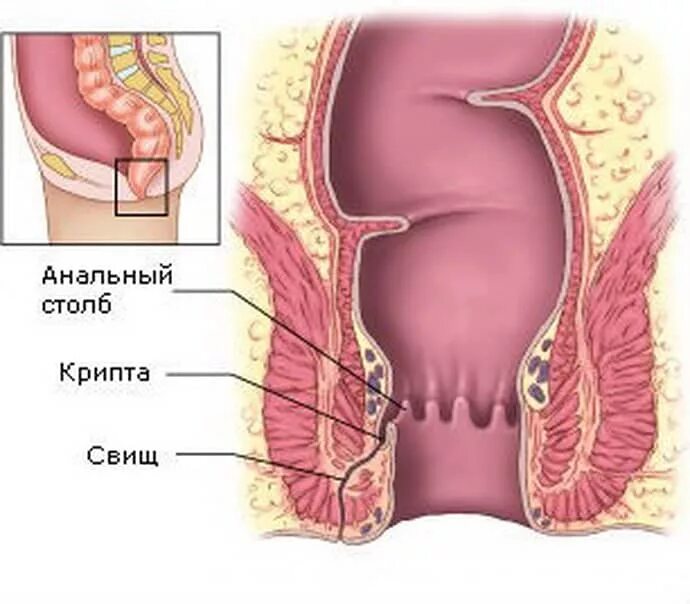 Сфинктерит прямой кишки симптомы