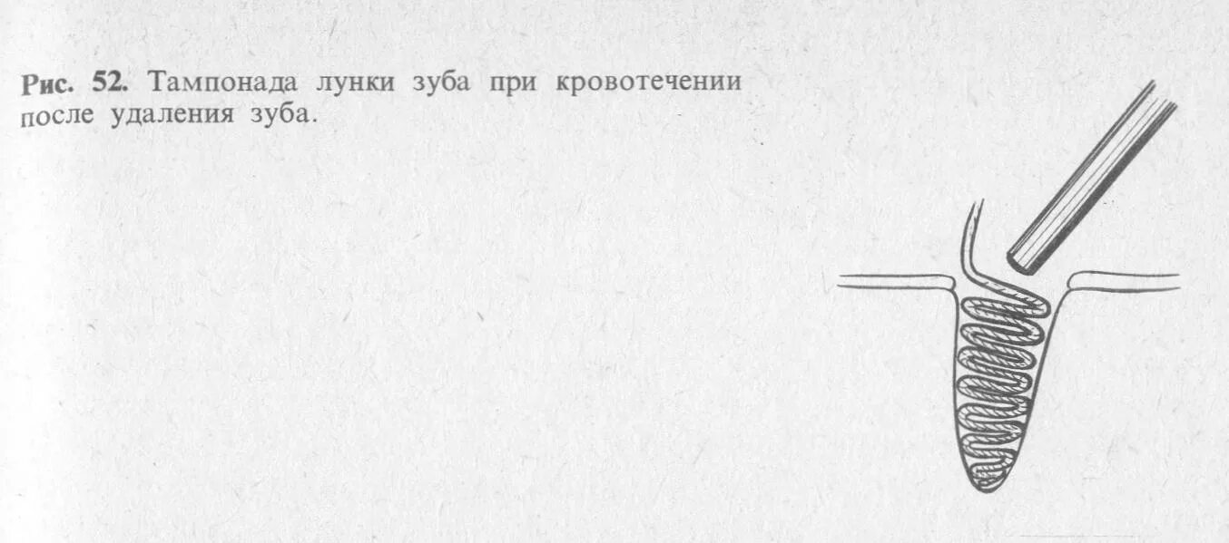 После удаления зуба через сколько убирать тампон. Тампонада лунки зуба алгоритм. Тампонада лунки удаленного зуба. Тампонада лунки после удаления зуба.