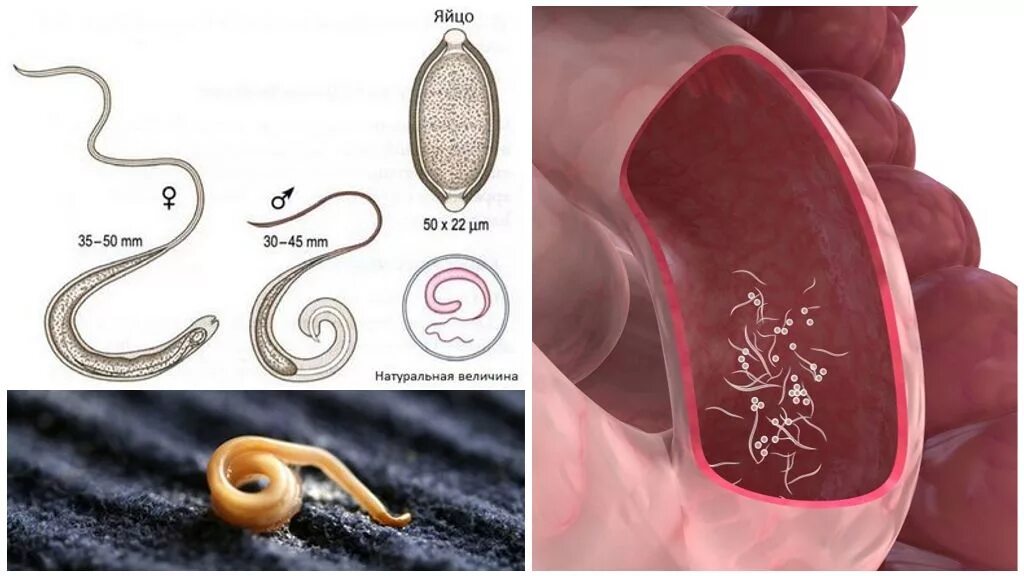 Червячки в заднем проходе. Червячки в заднем проходе. Острицы глисты гельминты. Острицы у детей под микроскопом. Острицы глисты гельминты.