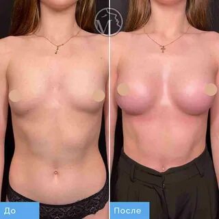 Как делают увеличение груди? 