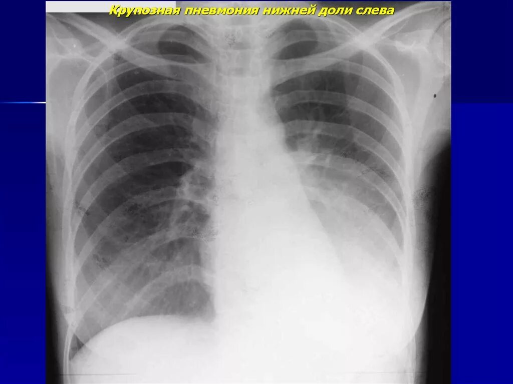 Крупозная пневмония рентгенограмма. Левосторонняя пневмония рентген. Левосторонняя нижнедолевая пневмония рентген. Крупозная пневмония рентген. Пневмония в нижней доле правого легкого