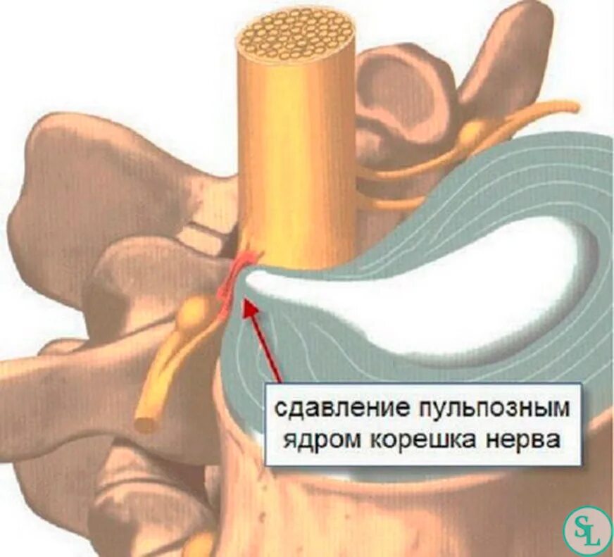 Защемление корешков в пояснице. Сдавление Корешков спинномозговых нервов. Межпозвоночная грыжа сдавление корешка. Компрессия корешка l5-s1 клиника. Сдавление корешка грыжей диска.