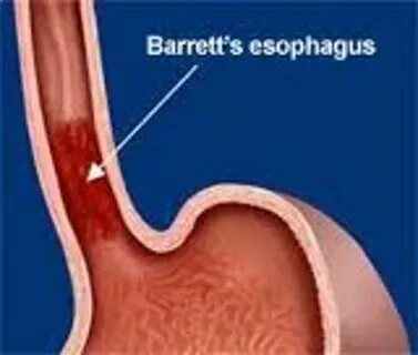 Esophageal cancer