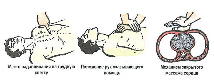Частота закрытого массажа сердца. Место надавливания на грудную клетку при закрытом массаже сердца. Техника надавливания на грудную клетку закрытый массаж сердца. Методика выполнения закрытого массажа сердца. Надавливание на грудную клетку при закрытом массаже.