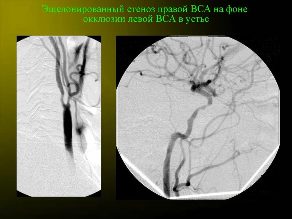 Стеноз устья вса. Стеноз правой внутренней сонной артерии.