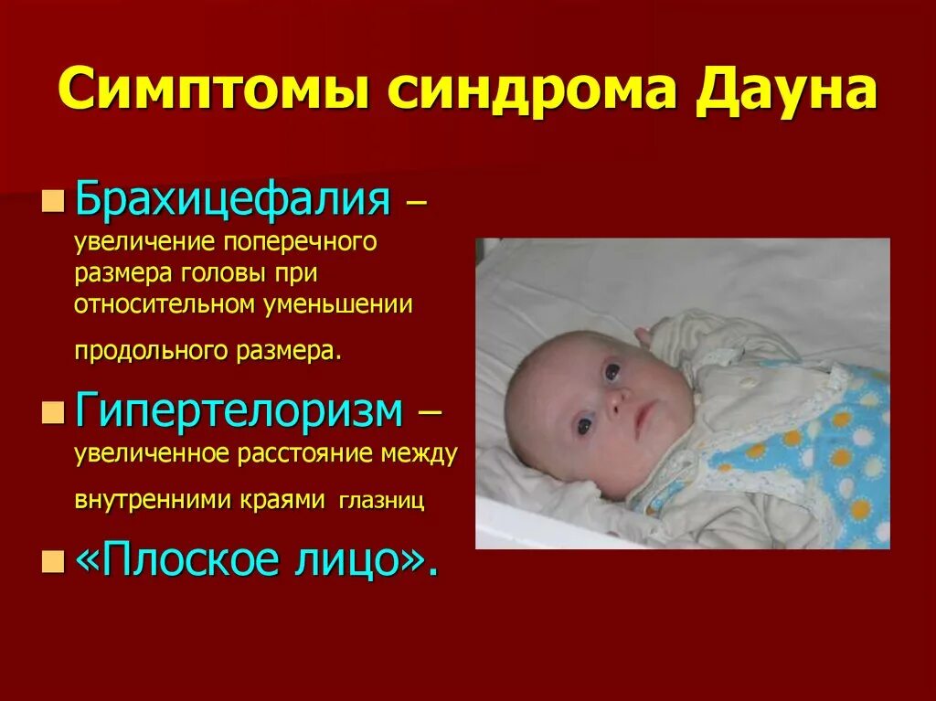 Роды дауна. Синдром Дауна у детей симптомы. Признаки Дауна у новорожденного ребенка. Симптомы синдрома Дауна у новорожденных.