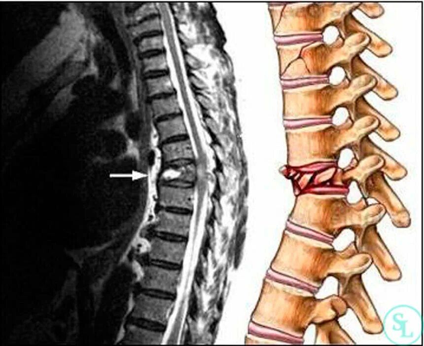 Повреждения позвоночника переломы. Компрессионный перелом 5 позвоночника. Компрессионный перелом th9 позвонка. Компрессионный перелом позвоночника th11-l1. Компрессионный перелом тела th8.