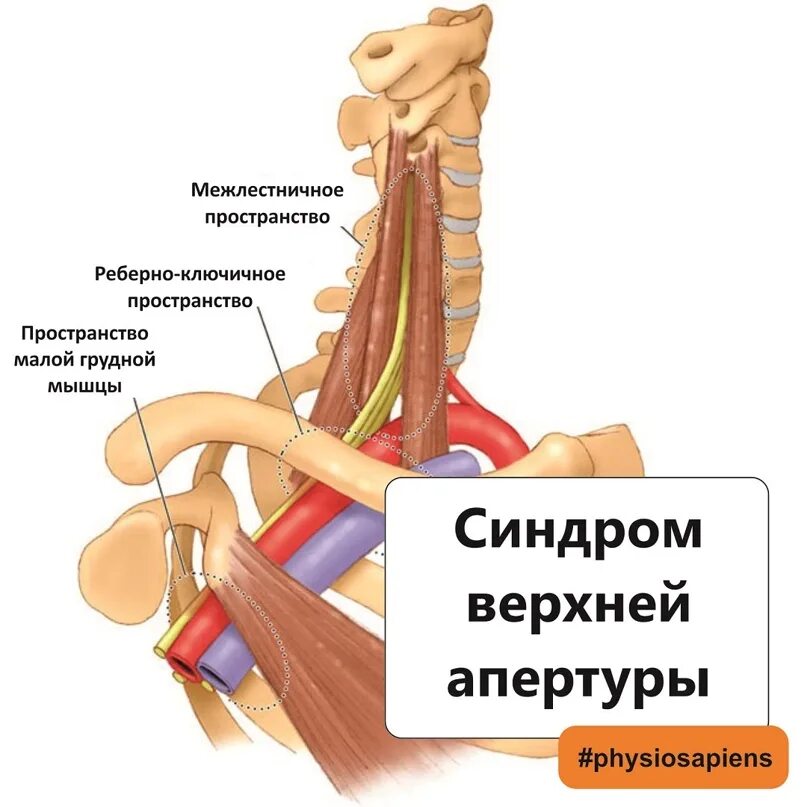 Предлестничное пространство. Синдром верхней апертуры. синдром грудной апертуры. синдром верхней апертуры грудной клетки. межлестничное пространство.