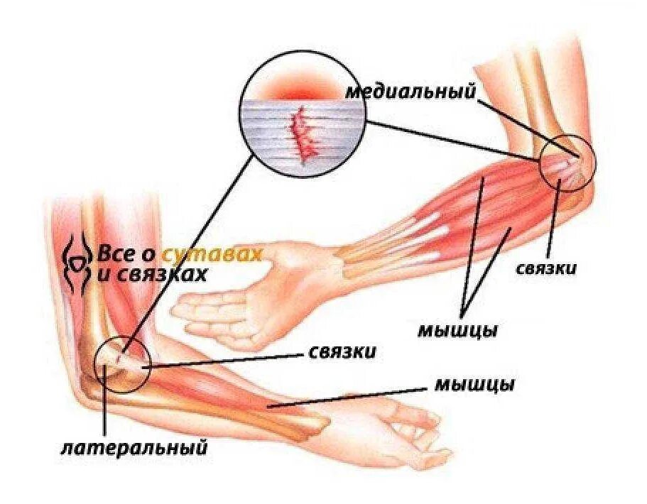 Связки на руке. Связки и сухожилия локтевого сустава. Медиальный эпикондилит сухожилия. Мышцы и сухожилия локтевого сустава. Периартрит локтевого сустава.