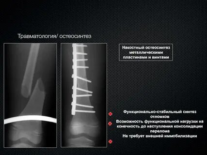 Остеосинтез травматология