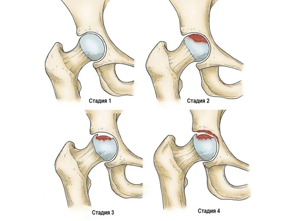 Степени некроза головки бедренной кости. Асептический некроз головки тазобедренного сустава стадии. Степени асептического некроза головки бедренной кости. Асептический некроз головки бедренной кости 2. Правый бедренный сустав