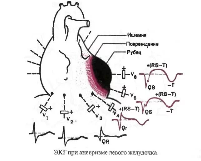 Рубцовые изменения миокарда на экг. Передне-перегородочный инфаркт миокарда на экг. Инфаркт без подъема st на экг. Рубец на экг. Рубец на сердце на экг что это такое.