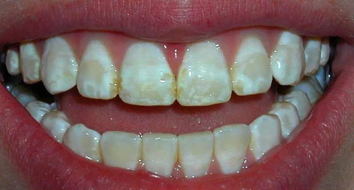 Меловидно крапчатый флюороз. Флюороз зубов (эндемический флюороз зубов) —. Эпидермический флюороз. Неприятное ощущение на зубах