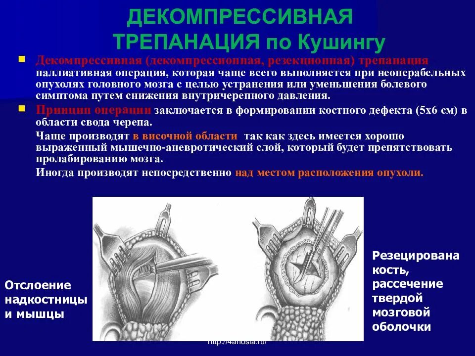 Костно-пластическая Трепанация. Декомпрессивная Трепанация черепа по Кушингу. Костно-пластическая Трепанация черепа ход операции. Декомпрессионная Трепанация черепа инструменты.