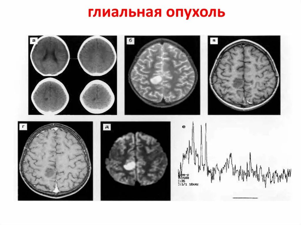 Глиальная опухоль головного мозга. Глиальные опухоли головного мозга классификация. Опухоли глиального ряда на мрт. Глиальная опухоль головного