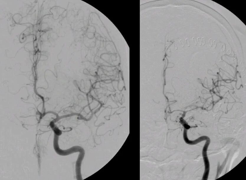 Артерии головного мозга симптомы. Ангиоспазм сосудов головного мозга симптомы. Вазоспазм сосудов головного. Стеноз артерий головного мозга. Спазм артерий головного мозга.