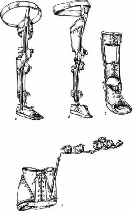 Аппарат на всю ногу. Шинно-кожаный аппарат Турнера. Ортопедический аппарат Лимберг. Аппарат на нижней конечности тутор для детей ДЦП. Ортопедический аппарат «тройник».