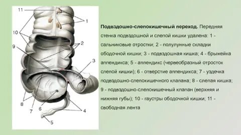 Левая подвздошная кишка