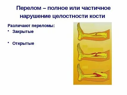 Переломы костей психосоматика