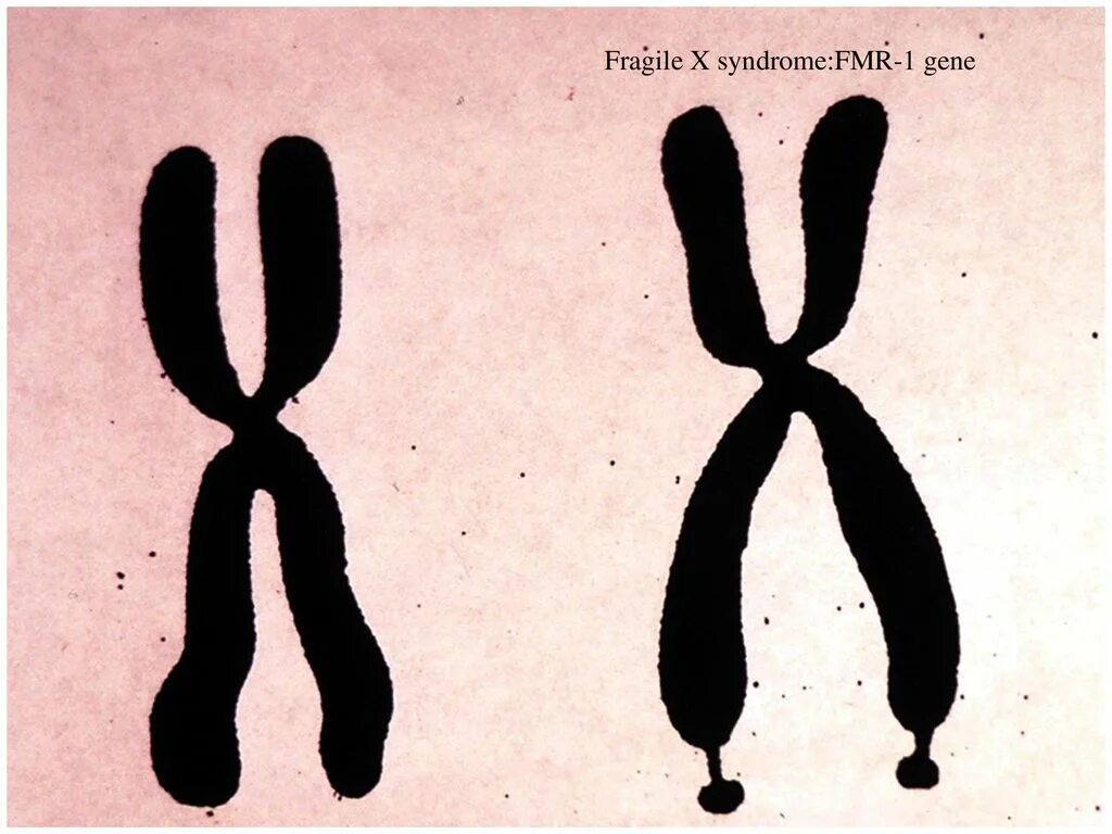 Вторая х хромосома. Х И У хромосомы. Одна хромосома. Синдром ломкой x-хромосомы.