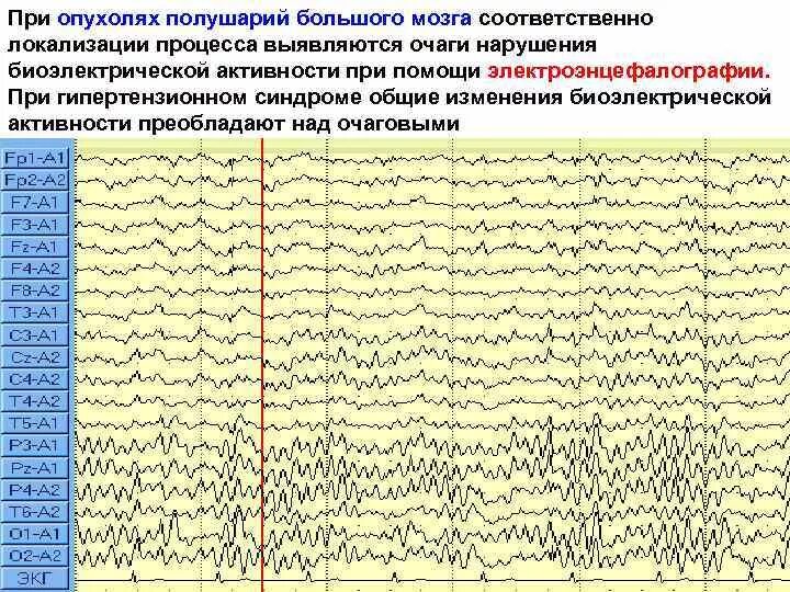 Дезорганизация головного мозга что это