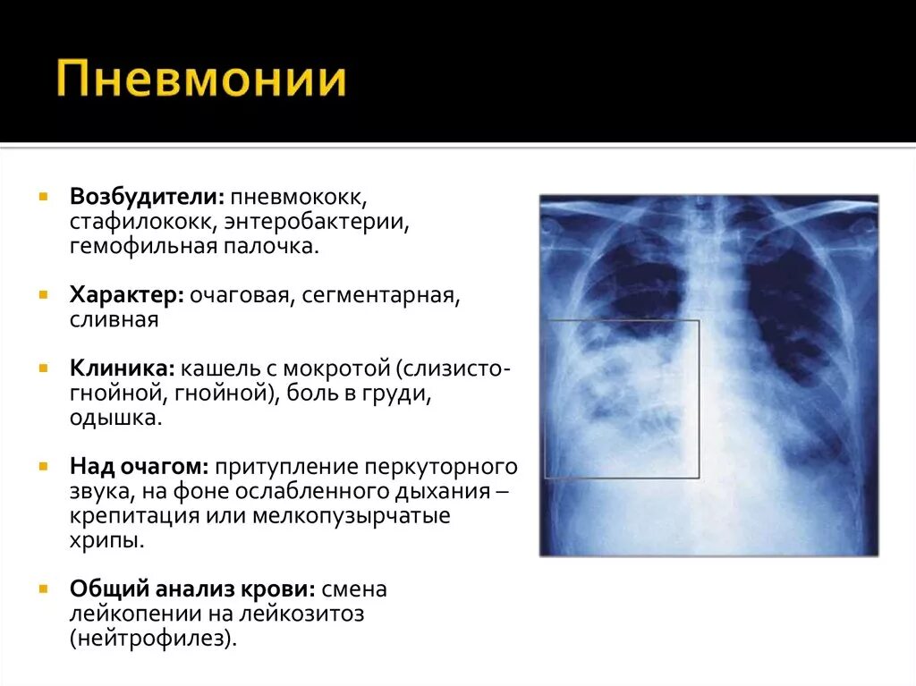 Пневмония признаки у взрослых