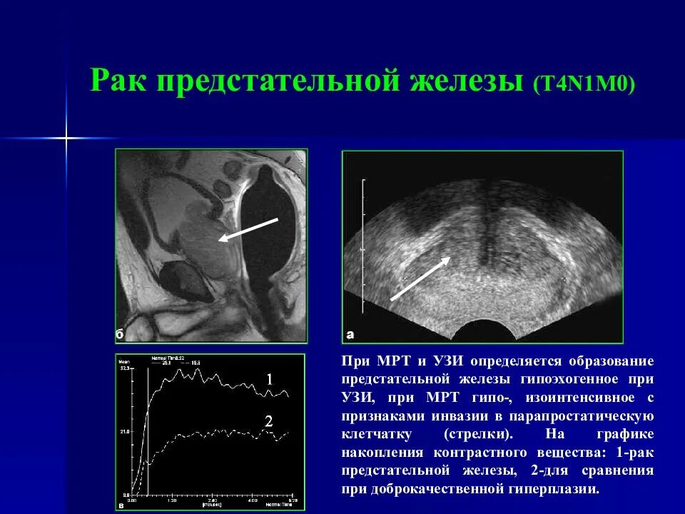 Диагноз рака простаты. УЗИ опухоль предстательной. УЗИ предстательной железы РПЖ. Диагностика опухолей предстательной железы. Объёмное образование предстательной железы на УЗИ.