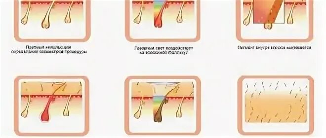 Рост волос на ногах. Схемы роста волос для депиляции. схема роста волос для шугаринга. методы избавления от нежелательных волос. этапы роста волос после лазерной эпиляции.